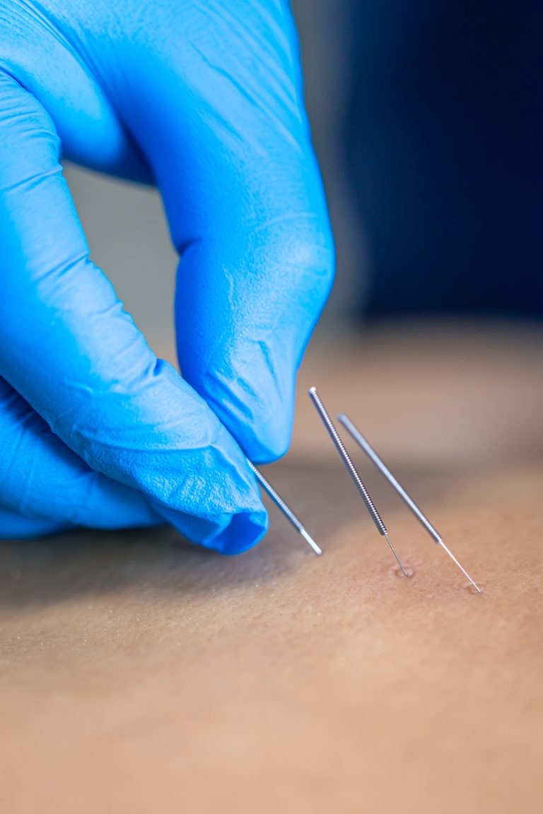 Close up of a needle and hands of physiotherapist doing a dry needling