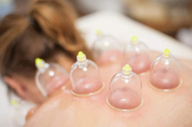 Vacuum cups with medical cupping therapy on a woman's back